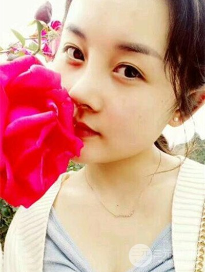成都艾美薇魏东隆鼻整形手术前后恢复果图分享