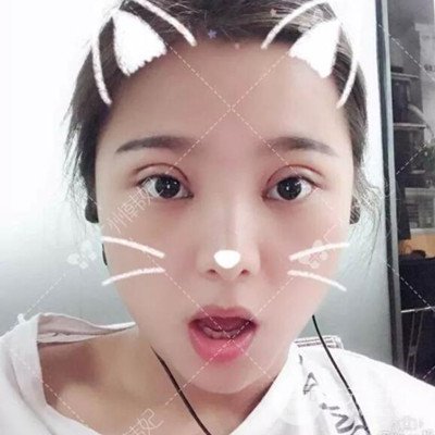 广州韩妃全切双眼皮案例日记分享~