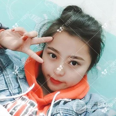 广州韩妃全切双眼皮案例日记分享~