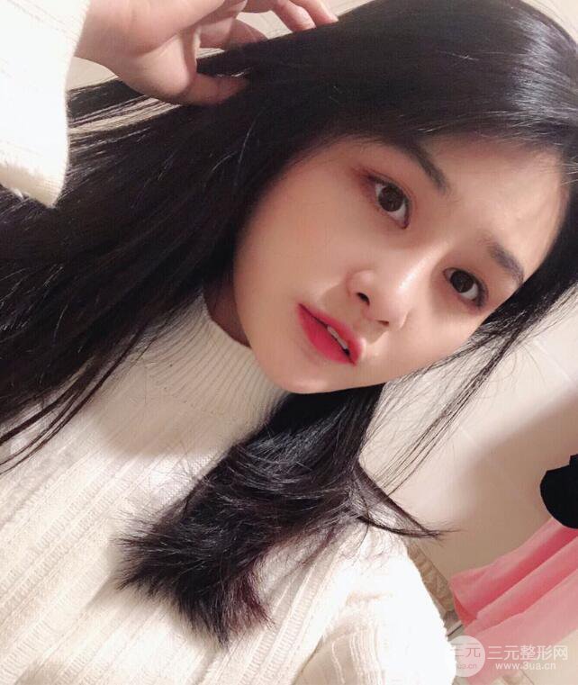 苏州紫馨顾陆健韩式隆鼻前后对比图|真人案例心情日记