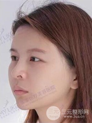 沈阳美莱高国林自体脂肪填充面部案例前后对比果图分享