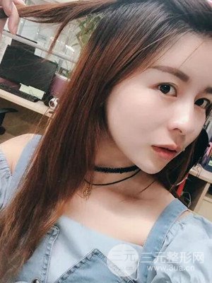 沈阳美莱高国林自体脂肪填充面部案例前后对比果图分享