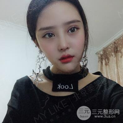 北京美莱赵峻贤隆鼻整形真实案例对比图恢复过程分享