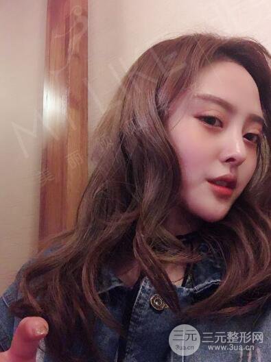 北京美莱赵峻贤隆鼻整形真实案例对比图恢复过程分享