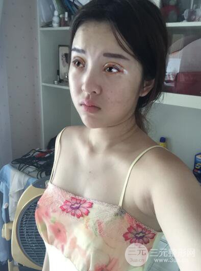 成都天使之翼张劲松切开双眼皮案例前后对比图心情小札