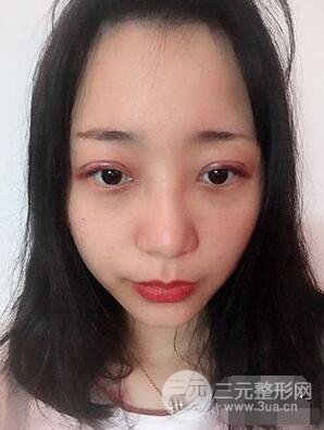 杭州华山连天美高俊明双眼皮案例前后对比图心情分享