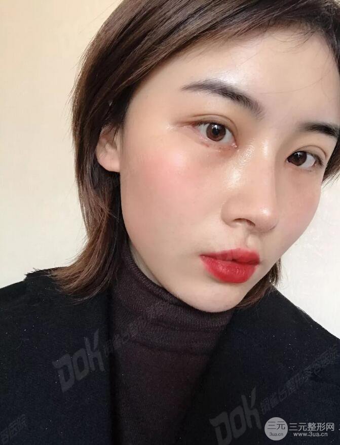 成都铜雀台切开双眼皮-45°原生开内眼角案例分享~