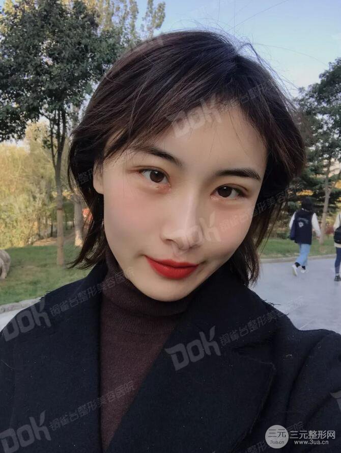 成都铜雀台切开双眼皮-45°原生开内眼角案例分享~