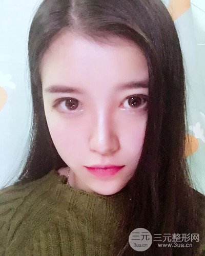 成都天使之翼金辉假体隆鼻案例前后对比图分享~
