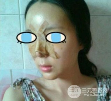 杭州华山连天美膨体隆鼻日记前后对比图分享~