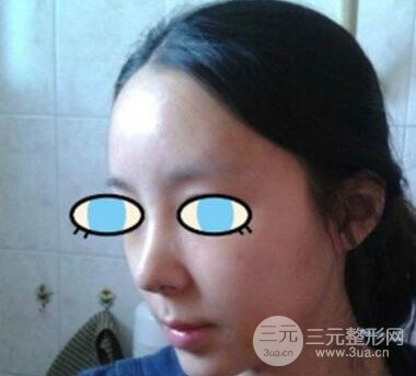 杭州华山连天美膨体隆鼻日记前后对比图分享~