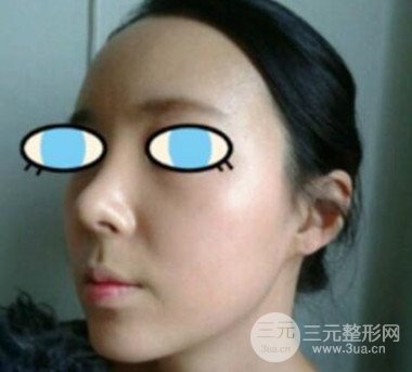 杭州华山连天美膨体隆鼻日记前后对比图分享~