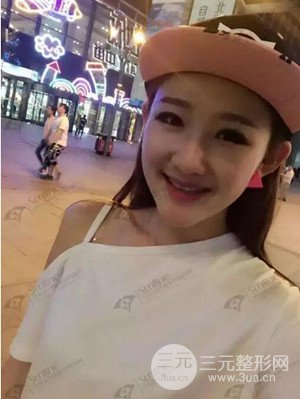 沈阳杏林史灵芝医生隆鼻整形案例日记分享~