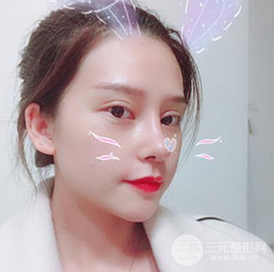 哈美莱郑东学隆鼻整形案例对比图真实心情分享哟~