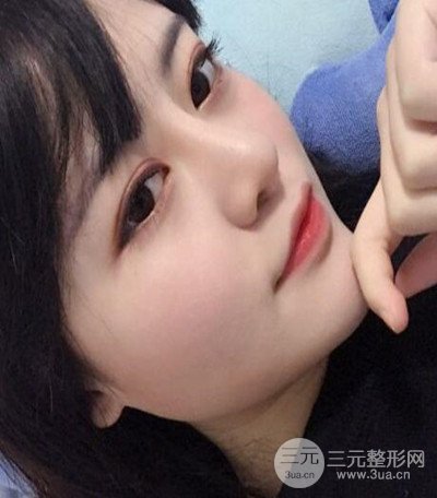 济南韩氏郭广科医生隆鼻案例分享~