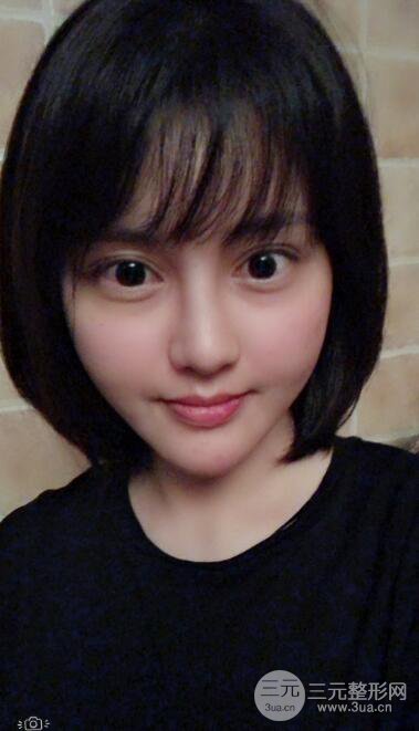 常州施尔美廉锋自体脂肪丰脸对照图案例心情日扎