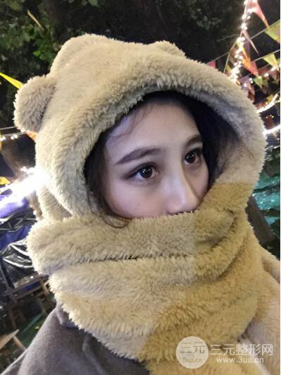 贵阳丽都李观龙隆鼻整形案例对照图一个月恢复过程分享