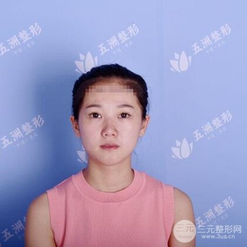 重庆五洲范文亮自体肋软骨隆鼻案例前后对比图分享~