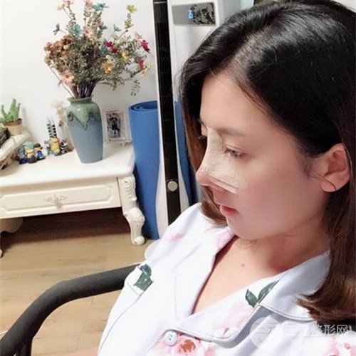 重庆五洲范文亮自体肋软骨隆鼻案例前后对比图分享~