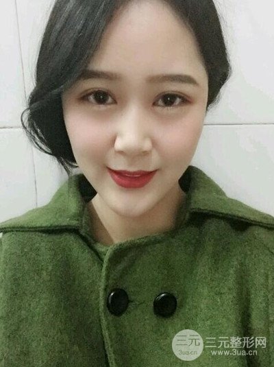 四川友谊李萍医生假体垫下巴前后对比果图片分享~