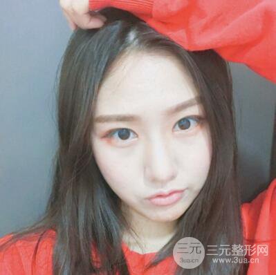 西安叶子鲁礼新埋线双眼皮案例对照图!两个月恢复心情小记