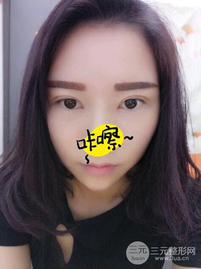 杭州艺之花杨海波全切双眼皮一个月的恢复记录分享~