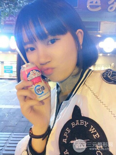 杭州艺之花杨海波全切双眼皮一个月的恢复记录分享~