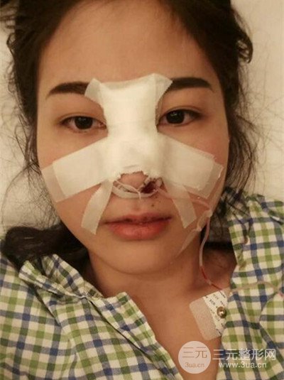 华人医联马丽医生膨体隆鼻日记分享