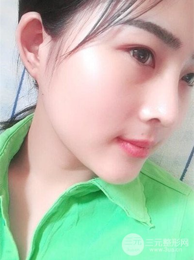 华人医联马丽医生膨体隆鼻日记分享