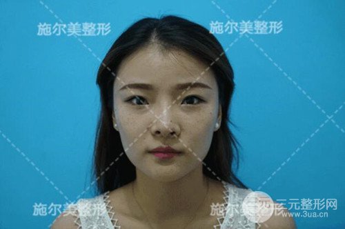 江苏施尔美自体脂肪详细部填充恢复记录前后对比图分享~