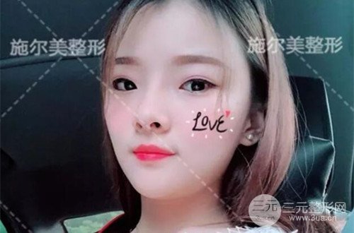 江苏施尔美自体脂肪详细部填充恢复记录前后对比图分享~