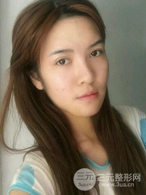 广州广美硅胶垫下巴恢复过程|前后对比照分享