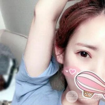 成都素美杨迪双眼皮案例前后对比照分享~