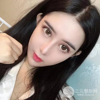 双眼皮修复案例恢复过程 双眼皮前后对比图分享