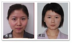 注射美容之注射瘦脸