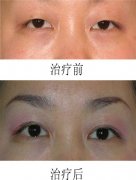汉密尔顿眼部整形之双眼皮形成术