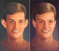 招风耳矫正须知 招风耳矫正须知