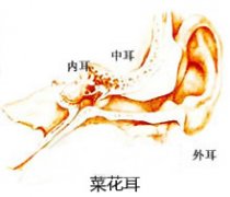 菜花耳矫正术缓解范围是什么?