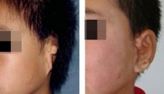 耳廓再造手术相关案例