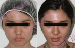 B****多久打一次