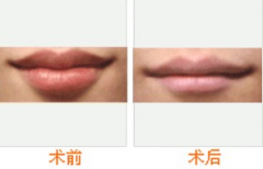 厚唇变薄术概述