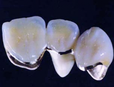 缺一颗牙做三颗烤瓷牙的设计原理