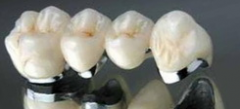 半贵金属烤瓷牙两种比较