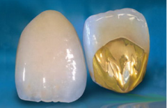 贵金属烤瓷牙的优点