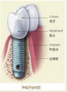 种植牙的简介
