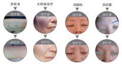 太田痣临床表现有哪些？