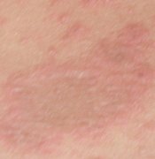 皮肤病的常见分类