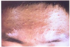 额部痤疮示例图