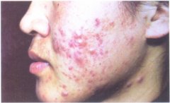 脸颊部痤疮示例图