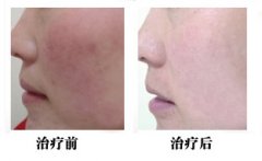 红血丝终结者 红血丝终结者